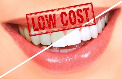 Riesgo del blanqueamiento dental low cost