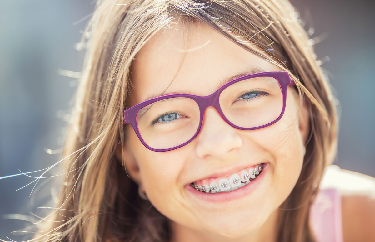 Brackets Damon, una ortodoncia perfecta para alinear la sonrisa de tus hijos