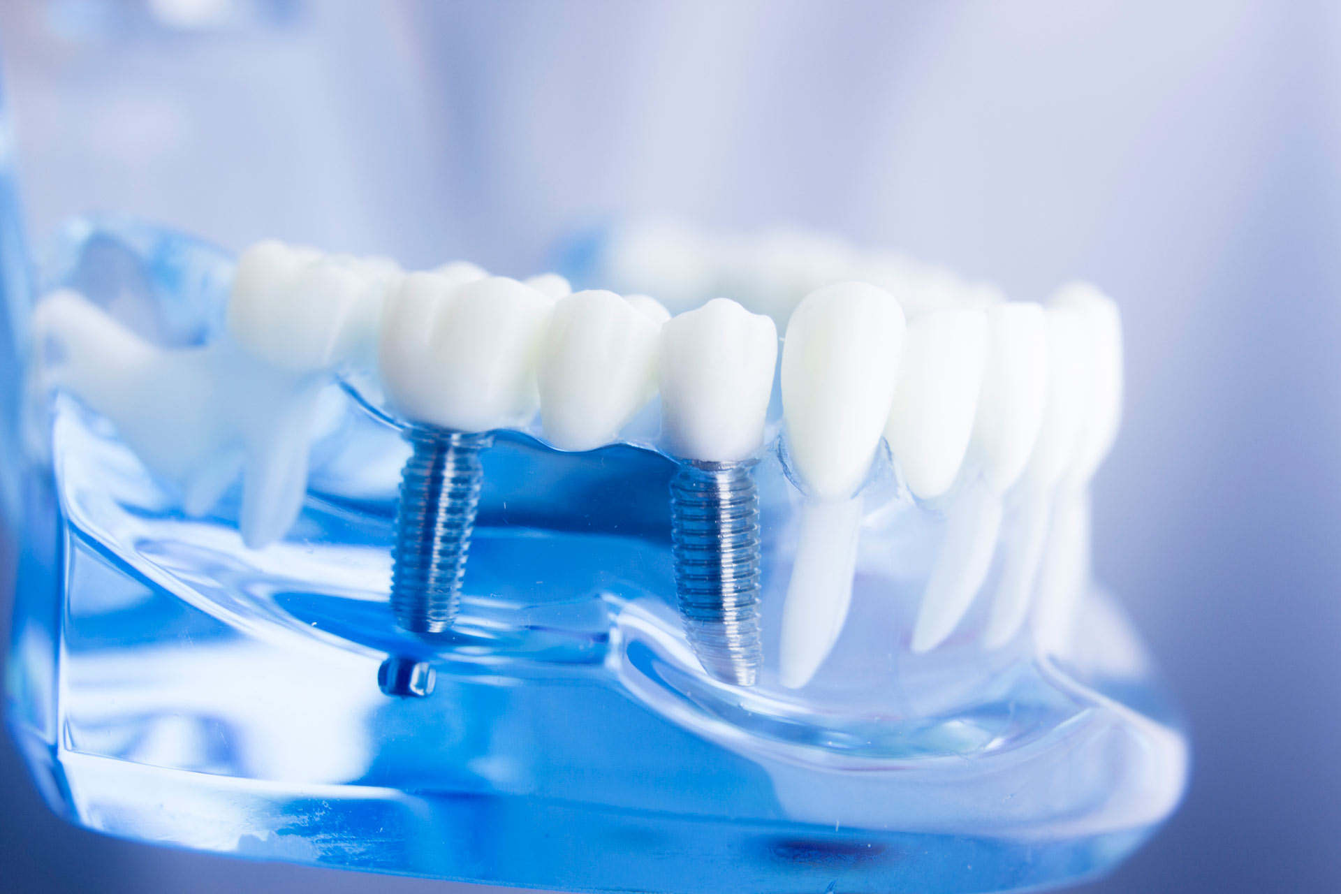 Mentiras, verdades y mitos sobre la implantología dental.