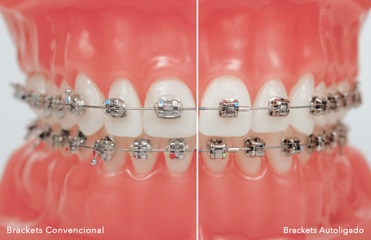Ortodoncia. ¿Por qué elegir Brackets de Autoligado?