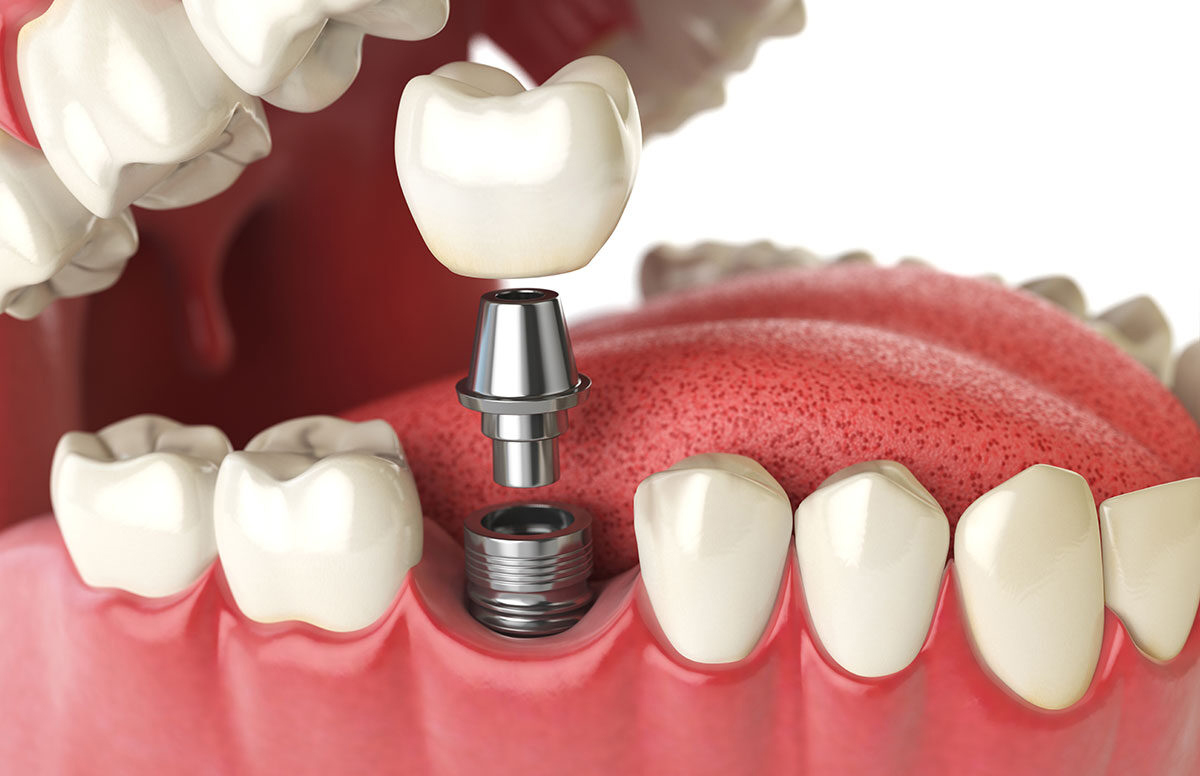 ¿Por qué es importante cubrir las ausencias dentales?