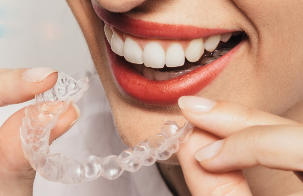 SecretAligner. La solución perfecta para tus tratamientos de ortodoncia invisible