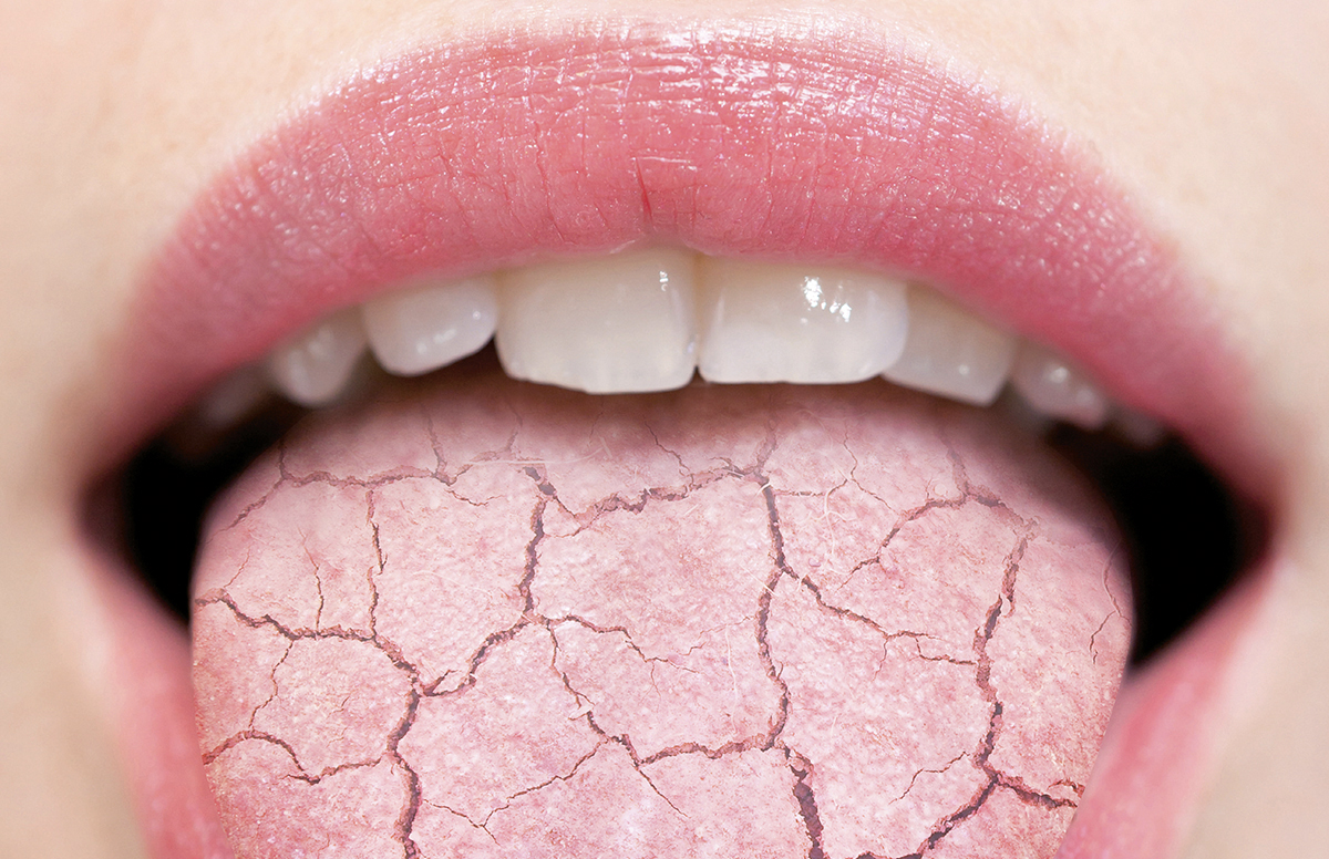 ¿Sequedad bucal o xerostomía? Aprende a combatirla